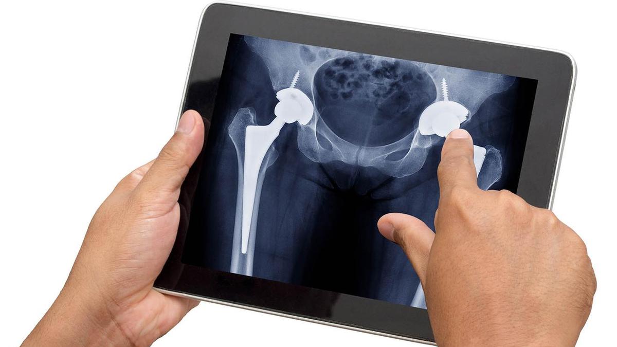 Why are Indians in their 30s increasingly having to get hip replacements?